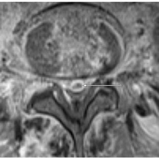 Sagittal T Weighted Fat Saturated Contrast Enhanced Image Of The