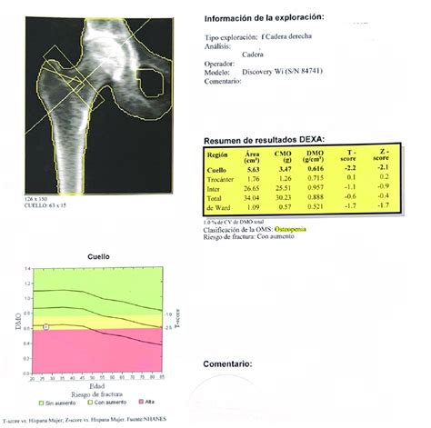 Densitometría ósea De Cadera Donde Se Diagnosticó De Osteopenia Download Scientific Diagram