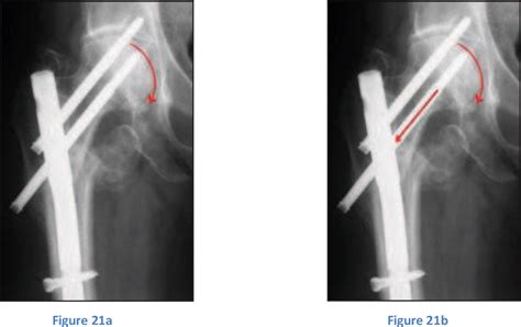 Figure From Prise En Charge Des Fractures Per Trochant Riennes