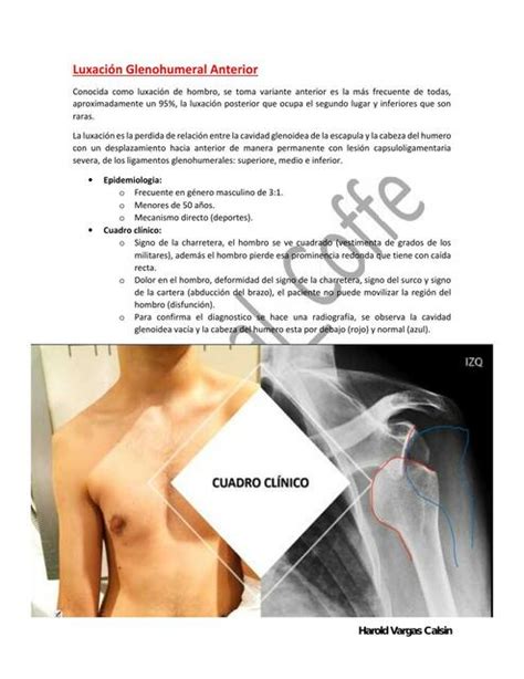 Luxación Glenohumeral Anterior Medical Coffe uDocz