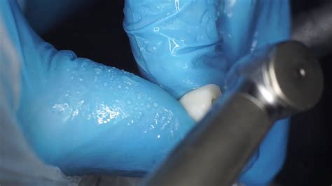 Access Cavity Demo Maxillary Premolar YouTube