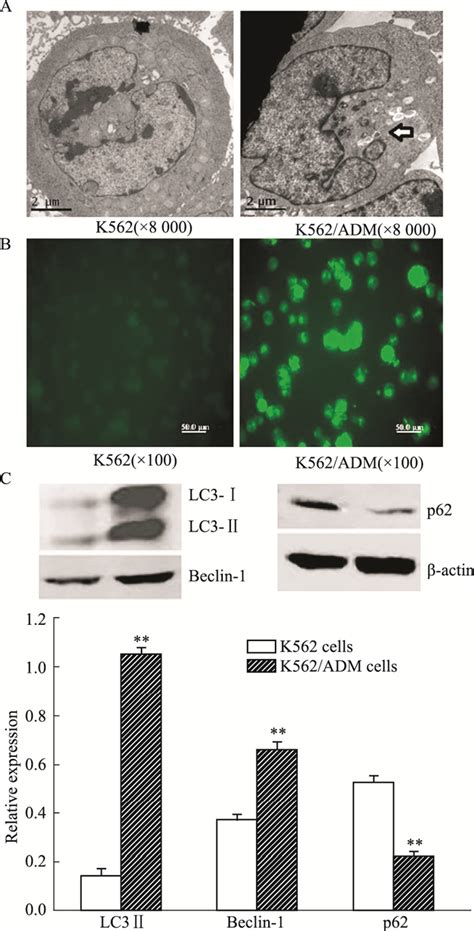 自噬水平与白血病K562 ADM细胞耐药的关系研究