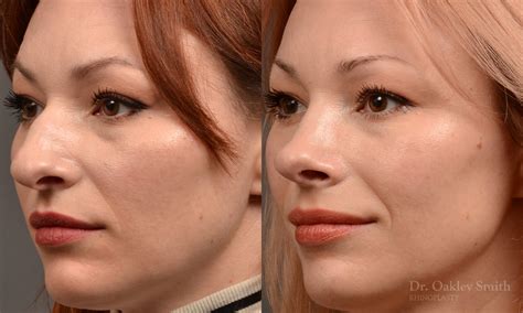 Rhinoplasty Before After Case 472 Toronto Rhinoplasty Surgery Nose