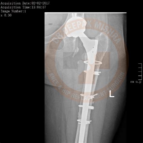 Primary And Revision Total Hip Replacement Surgery