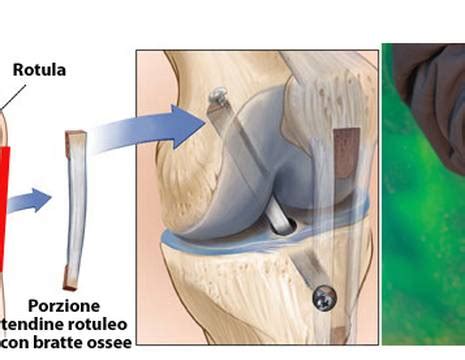 Operazione Crociato Anteriore Ricostruzione Del Legamento
