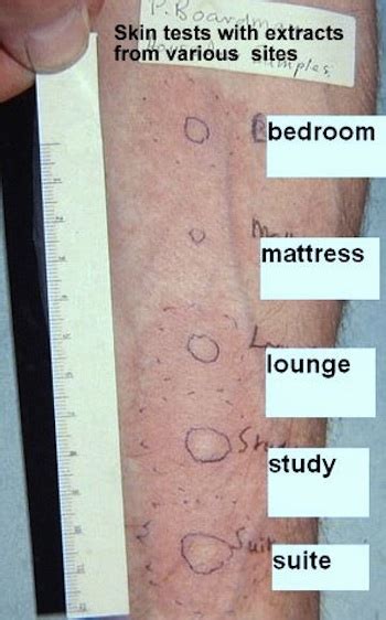 Skin Prick Testing Examples Of Allergic Reactions