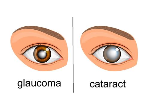 Difference Between Cataract And Glaucoma Surgery By Balaji Ent And Eye