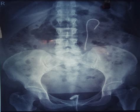 Successful retrieval of stent along with encrustations seen in distal... | Download Scientific ...