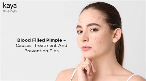 Blood Filled Pimples: Causes, Treatments, Prevention Tips - Blog