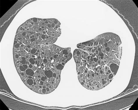 High Resolution Computed Tomography Scan Slice From Showing