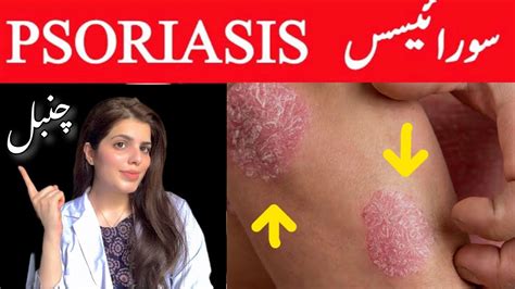 Psoriasis Treatment Chambal ka Ilaj सरयसस YouTube