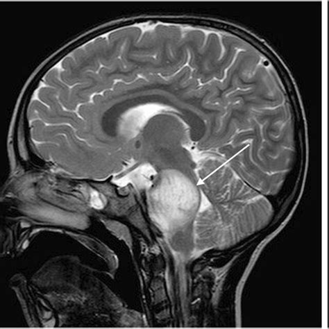 Tectal Glioma Causing Hydrocephalus In A 14 Year Old Boy A Sagittal