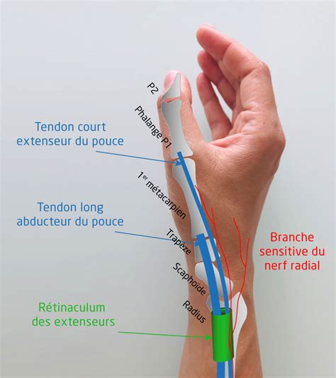 La Tendinite De De Quervain Im2s