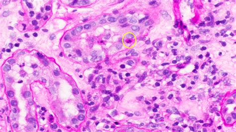 Pathology Outlines - Tubulointerstitial nephritis-general