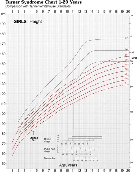 Turner Syndrome Height