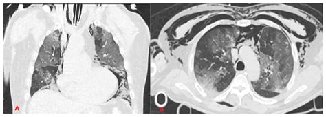 Biomedicines Free Full Text Iatrogenic Barotrauma In Covid 19