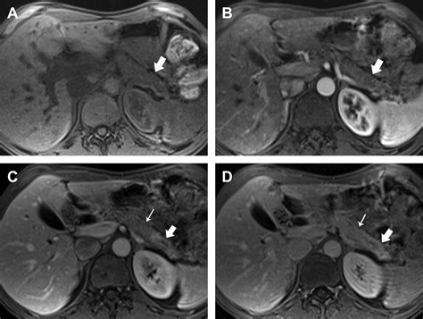 MR Imaging of Autoimmune Pancreatitis - Magnetic Resonance Imaging Clinics