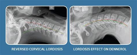 Spinal Curve Correction Evolved Spine Chiropractic