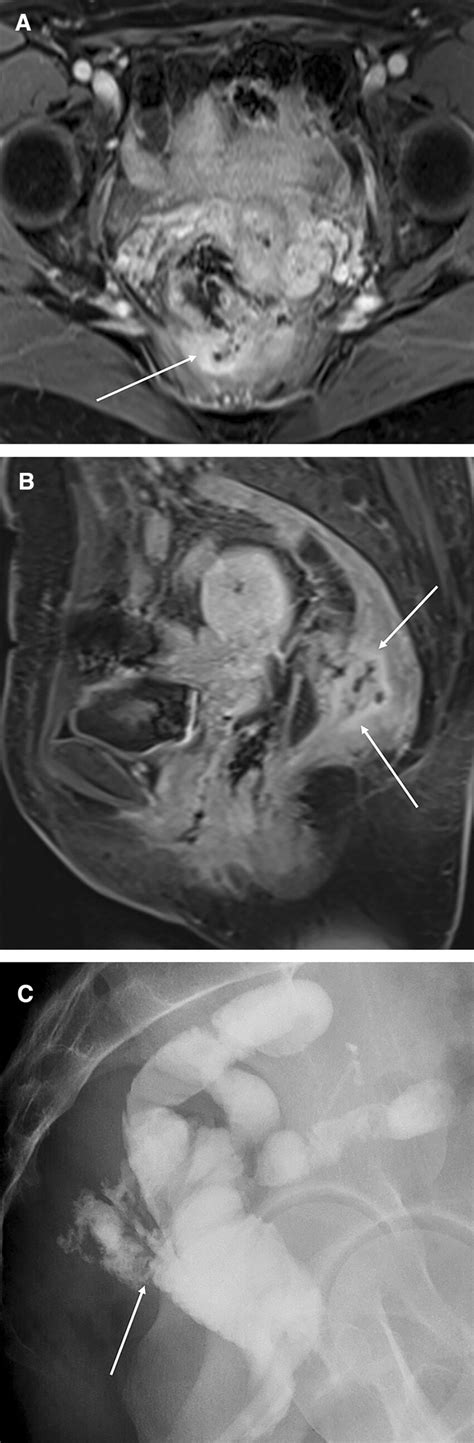 A Axial And B Sagittal T1 Weighted Fat Saturated Post Contrast And C