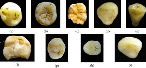 Fossilized occlusal surfaces on Homo sapiens teeth from Lang Trang... | Download Scientific Diagram