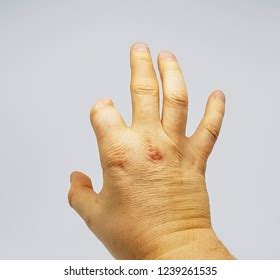 Amputated Finger Images, Stock Photos & Vectors | Shutterstock