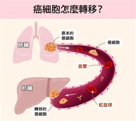 癌症晚期可以治癒嗎？！一篇弄懂癌症免疫治療