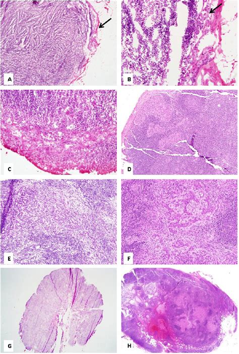 PDF Intraoperative Frozen Section Sentinel Lymph Node Assessment In