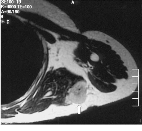 Figure 1 from Alveolar soft part sarcoma in the region of the axilla: a ...