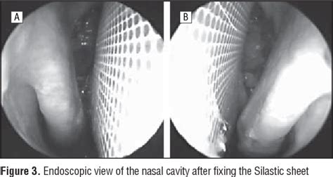 Figure 4 from Preventing lateral synechia formation after endoscopic ...