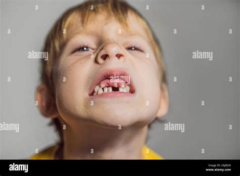 Abnormal Boy Tooth The Extra Narrow Strange Tooth Grew In The Boys