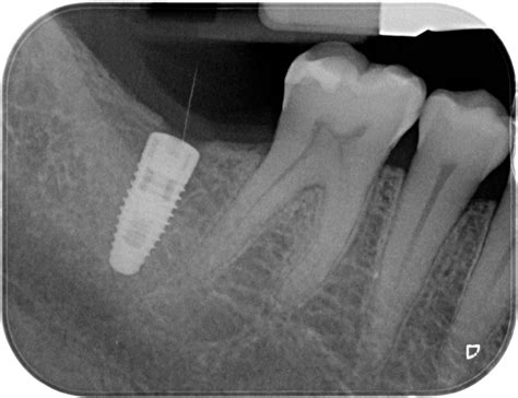 Nuoss Taper Bone Plug Informacionpublica Svet Gob Gt