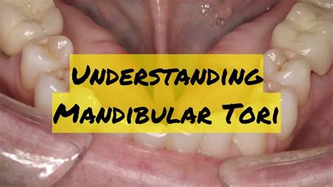 Understanding Mandibular Tori Causes Treatment And Concerns