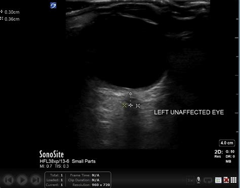 Acute Optic Neuritis Diagnosed By Bedside Ultrasound In An Emergency Department Journal Of