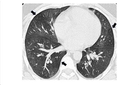 Expiratory High Resolution Computed Tomography Hrct Revealed