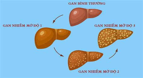 Gan Nhiễm Mỡ Độ 1 Nguyên Nhân Dấu Hiệu và Cách Điều Trị Công ty cổ