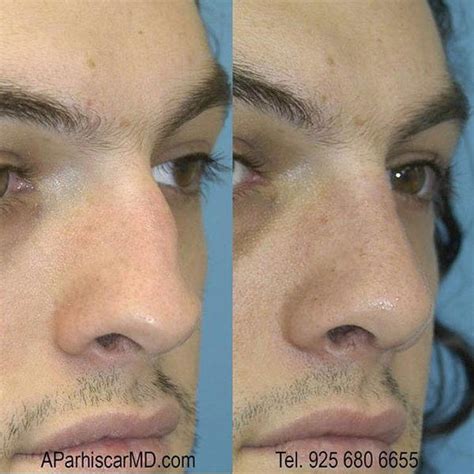 Crooked Nose Help Rhinoplasty Cost Pics Reviews Q A