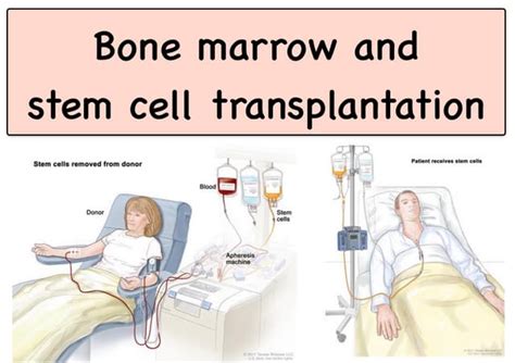 12.1. Stem Cell Transplantation.pdf