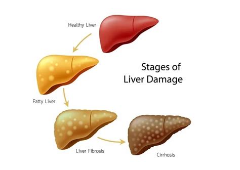 Fatty Liver Hidden Killer Types And Early Warning Signs