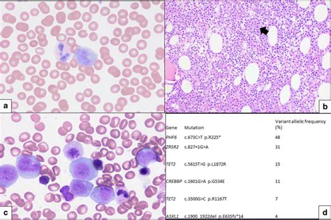 Myeloid Neoplasm With Eosinophilia And A Cryptic PDGFRB Rearrangement