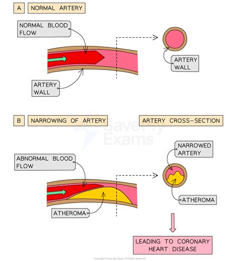 Cardiovascular Disease Wjec Gcse Biology Combined Science Revision