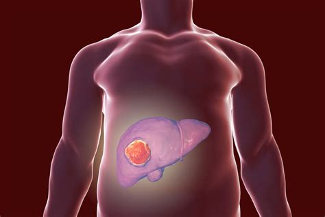 Hépatocarcinome Symptômes Traitement Quel Pronostic