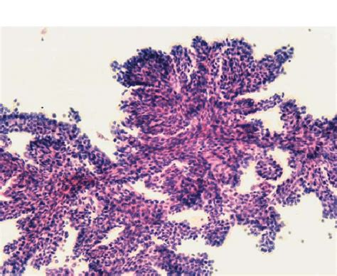 Carcinoma de células renales tipo papilar Fragmento de estructuras