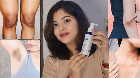 Skin Darkness Kaise Dur Kare How To Reduce Underarms Knees Elbow Neck