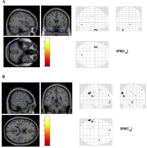 One Year Follow Up Examination A Positive Correlation Between Left