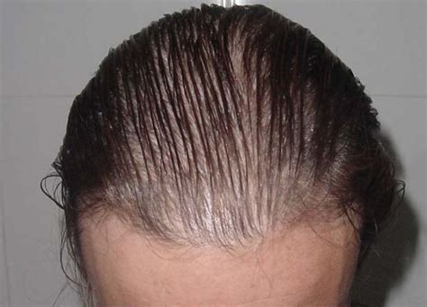 Alopecia Difusa Causas Y Tratamientos