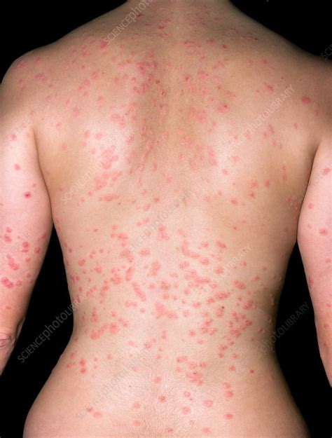 Guttate Psoriasis