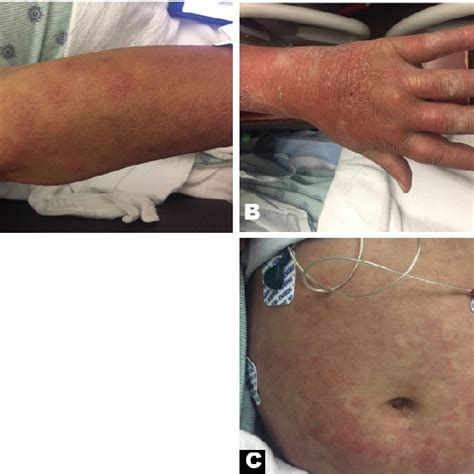 A C Red Indurated Dermal Papules And Nodules On A Forearms B Download Scientific Diagram