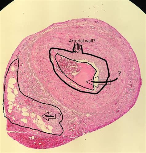 Temporal Artery Biopsy 1 : r/medicine