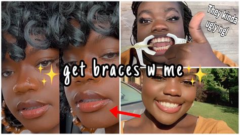 Getting Braces Vlog Youtube