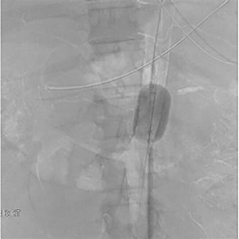 Fluoroscopic Image Demonstrating Endovascular Balloon Occlusion Of